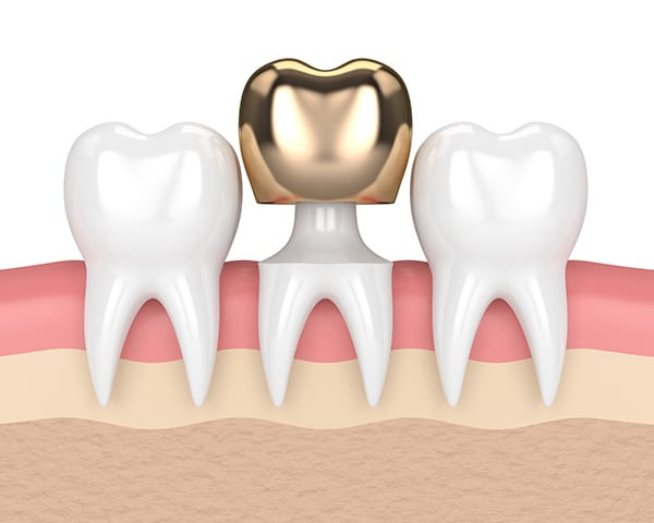 Gold Dental Crown image