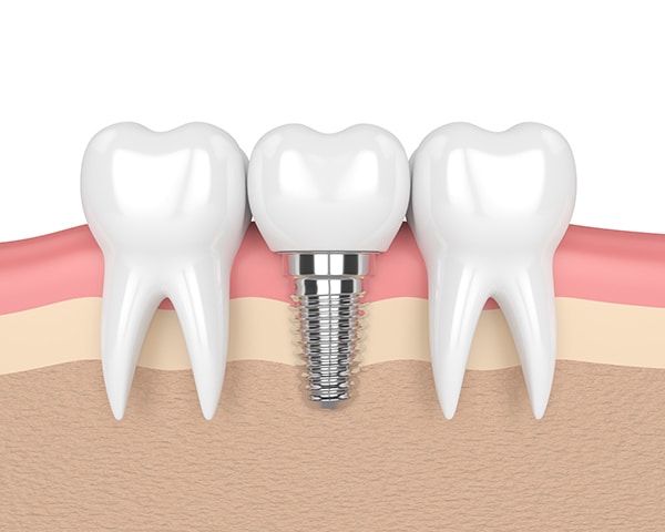Dental Implant image