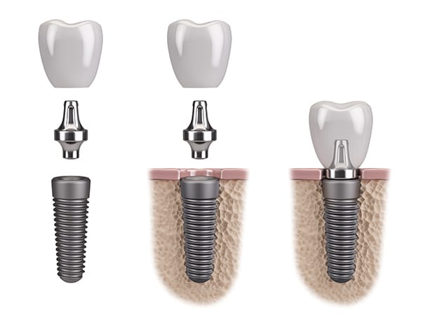 Dental Implant Components image