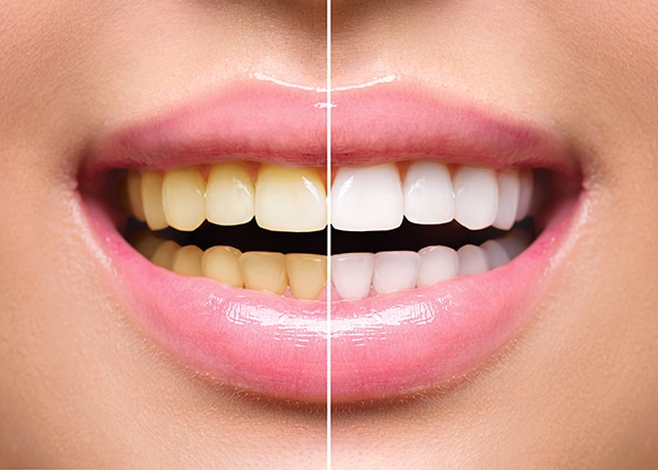 Teeth Whitening image