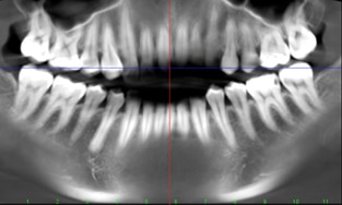 dental radiology fmx