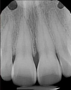 Dental X-Ray image