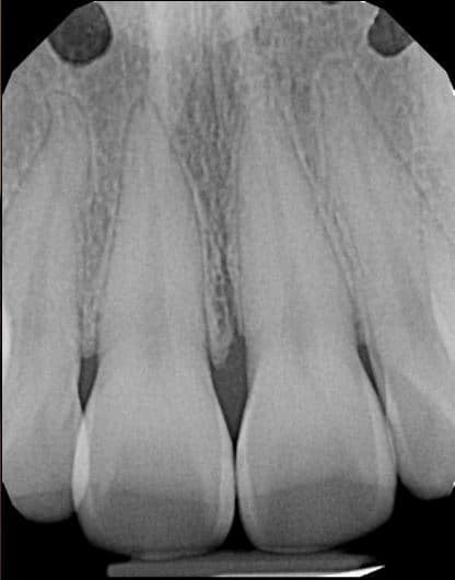 Dental X-Ray image