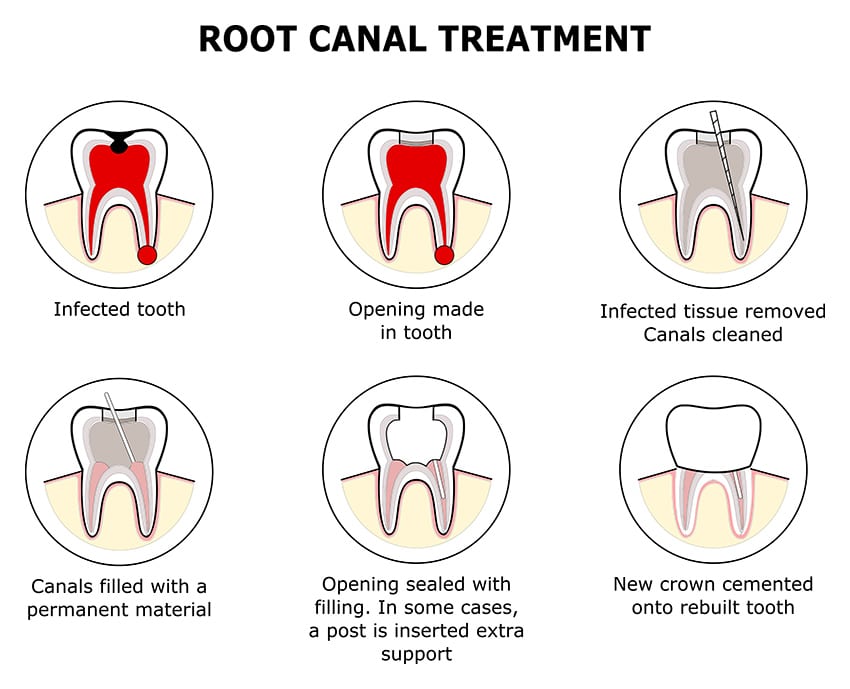 Root Canal Treatment Part 2: Top 10 Common Reasons For Why they Fail