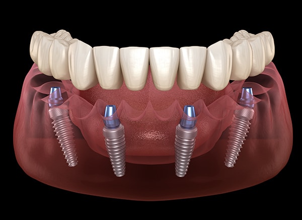 All On 4 Dental Implants photo