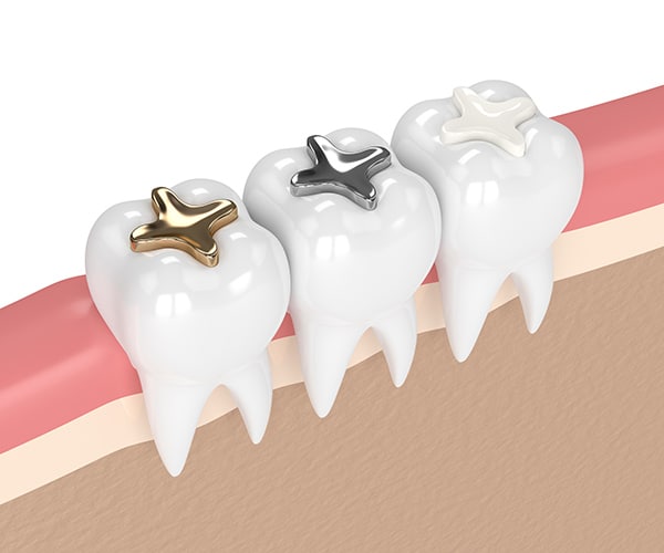 Dental Fillings Portland OR - Tooth-colored Composite Fillings