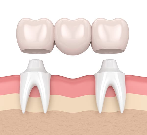 Dental Bridge image