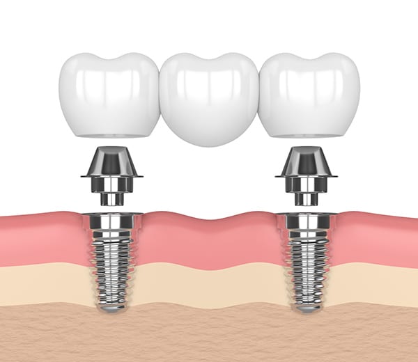 Dental Implant Supported Bridge image